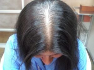Paciente femenino con Alopecia androgénica