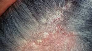 Enfermedades del cuero cabelludo - Dermatitis Seborreica
