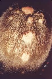 Enfermedades del cuero cabelludo - Paciente con tinea capitis