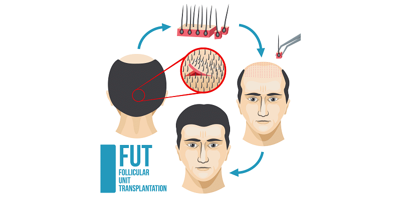 Técnica de Trasplante de Unidades foliculares FUT