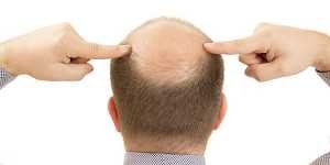 Caída del cabello - alopecia androgénica