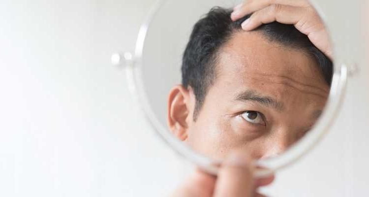 Caída del cabello ⋆ Los 7 tipos más comunes de alopecia