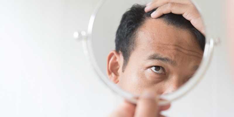 Caída del cabello ⋆ Los 7 tipos más comunes de alopecia