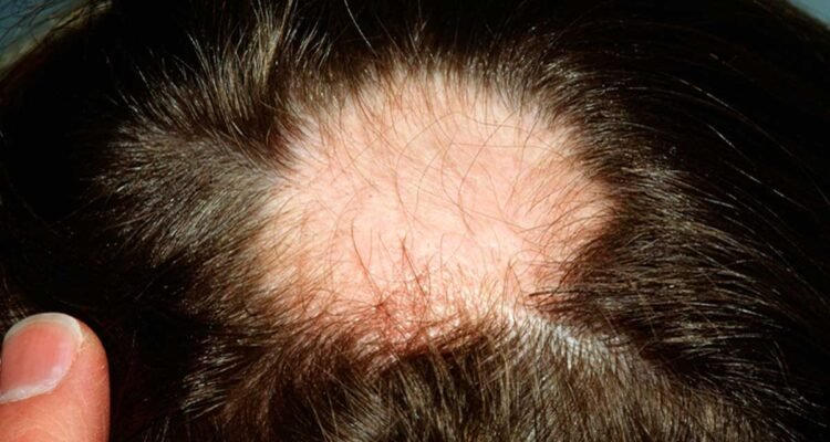 Alopecia difusa: síntomas, causas y tratamiento