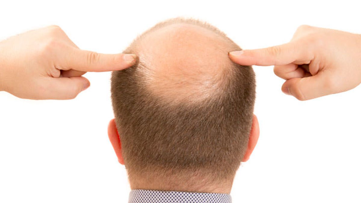 ¿Qué es la Bicalutamina? Usos y beneficios para la alopecia androgénica
