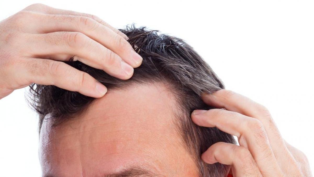 Tratamiento con Dutasteride para evitar la caída del pelo
